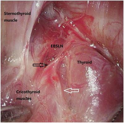 Utility of video-assisted method for identifying and preserving the external branch of the superior laryngeal nerve during thyroidectomy